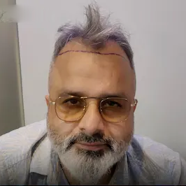 Before hair transplant of an older man at Evolved Hair Bangladesh showing visible hair thinning and hair loss