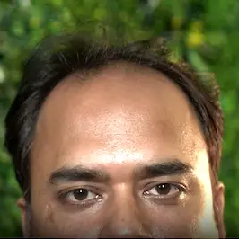 Before hair transplant of a middle-aged man at Evolved Hair Bangladesh showing visible hair thinning and receding hairline.
